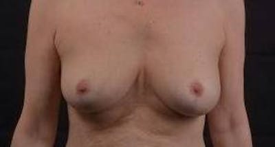 Mastopexy Before & After Gallery - Patient 159407 - Image 2