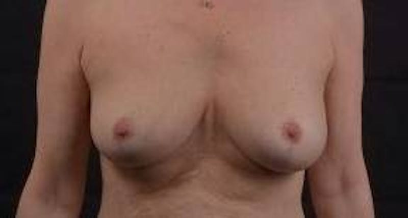Mastopexy Before & After Gallery - Patient 159407 - Image 2