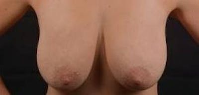 Mastopexy Before & After Gallery - Patient 809175 - Image 1