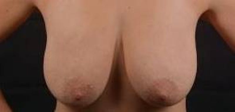 Mastopexy Before & After Gallery - Patient 809175 - Image 1
