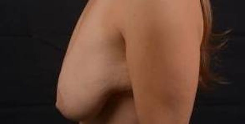 Mastopexy Before & After Gallery - Patient 809175 - Image 3