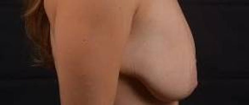 Mastopexy Before & After Gallery - Patient 809175 - Image 5