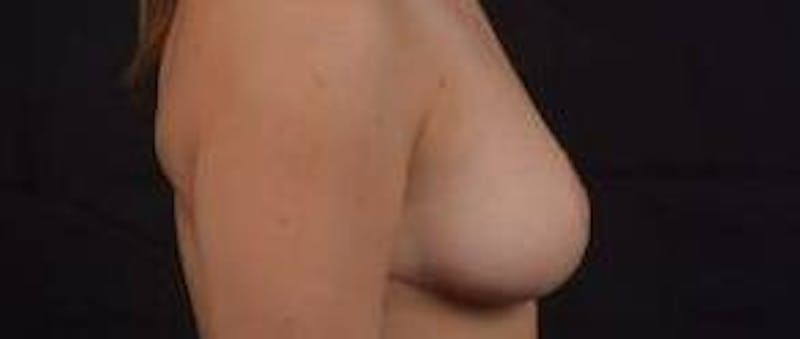 Mastopexy Before & After Gallery - Patient 809175 - Image 6