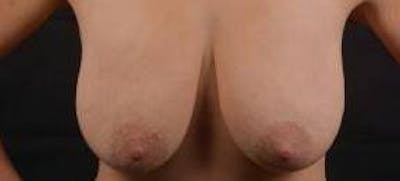 Mastopexy Before & After Gallery - Patient 185322 - Image 1