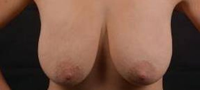 Mastopexy Before & After Gallery - Patient 185322 - Image 1