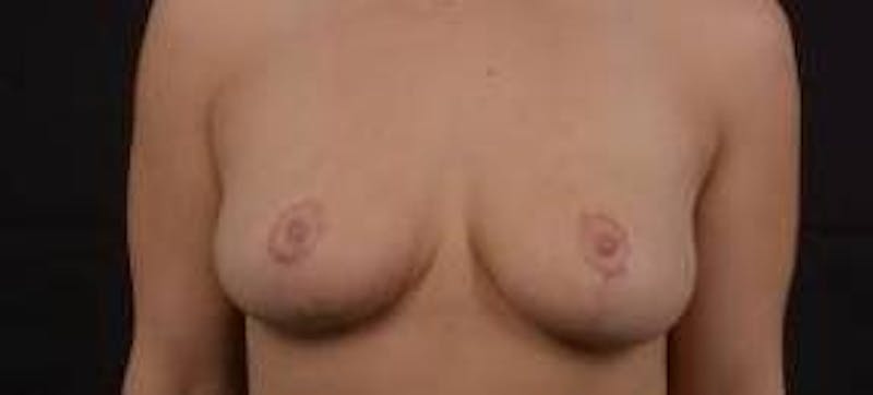 Mastopexy Before & After Gallery - Patient 185322 - Image 2