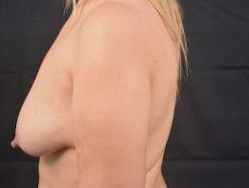 Mastopexy Before & After Gallery - Patient 163580 - Image 3