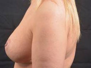 Mastopexy Before & After Gallery - Patient 163580 - Image 4