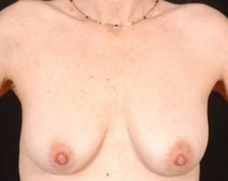 Mastopexy Before & After Gallery - Patient 455749 - Image 1