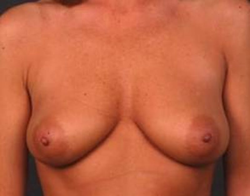 Mastopexy Before & After Gallery - Patient 271546 - Image 1
