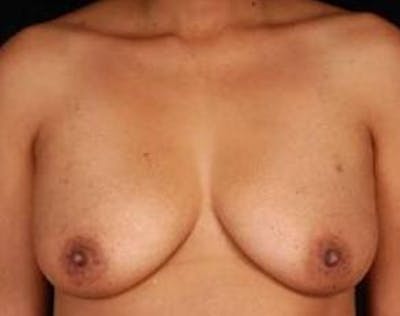 Mastopexy Before & After Gallery - Patient 133050 - Image 1