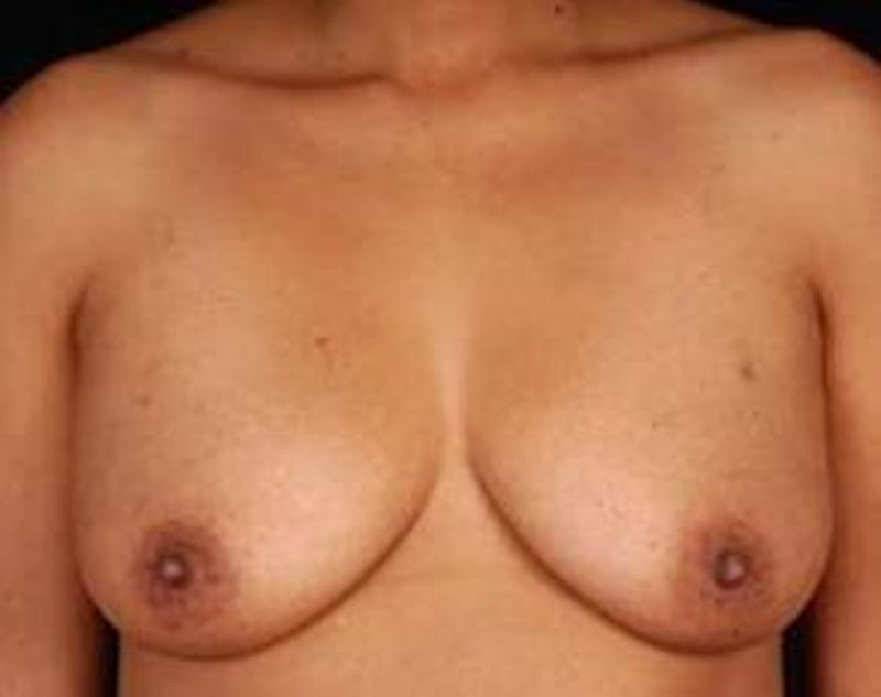 Mastopexy Before & After Gallery - Patient 133050 - Image 1