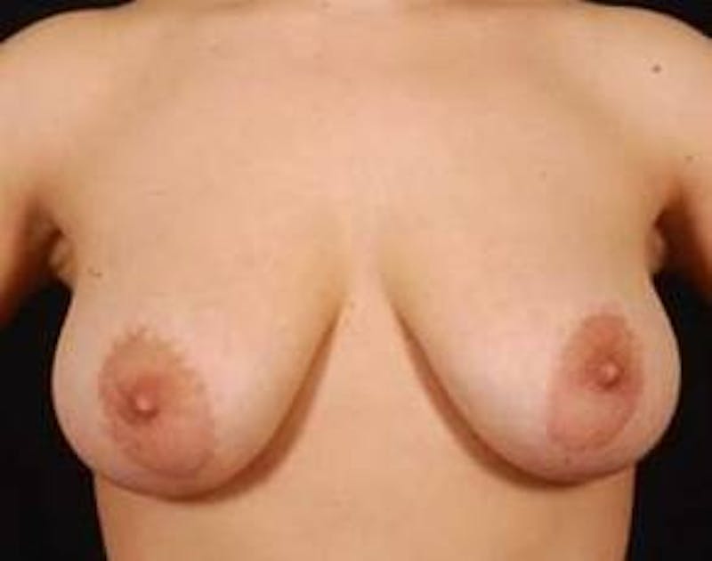 Mastopexy Before & After Gallery - Patient 368414 - Image 1