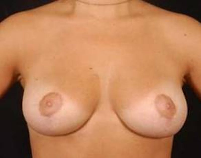 Mastopexy Before & After Gallery - Patient 368414 - Image 2