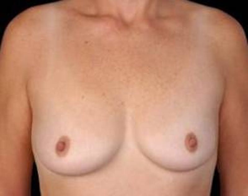 Mastopexy Before & After Gallery - Patient 354468 - Image 1