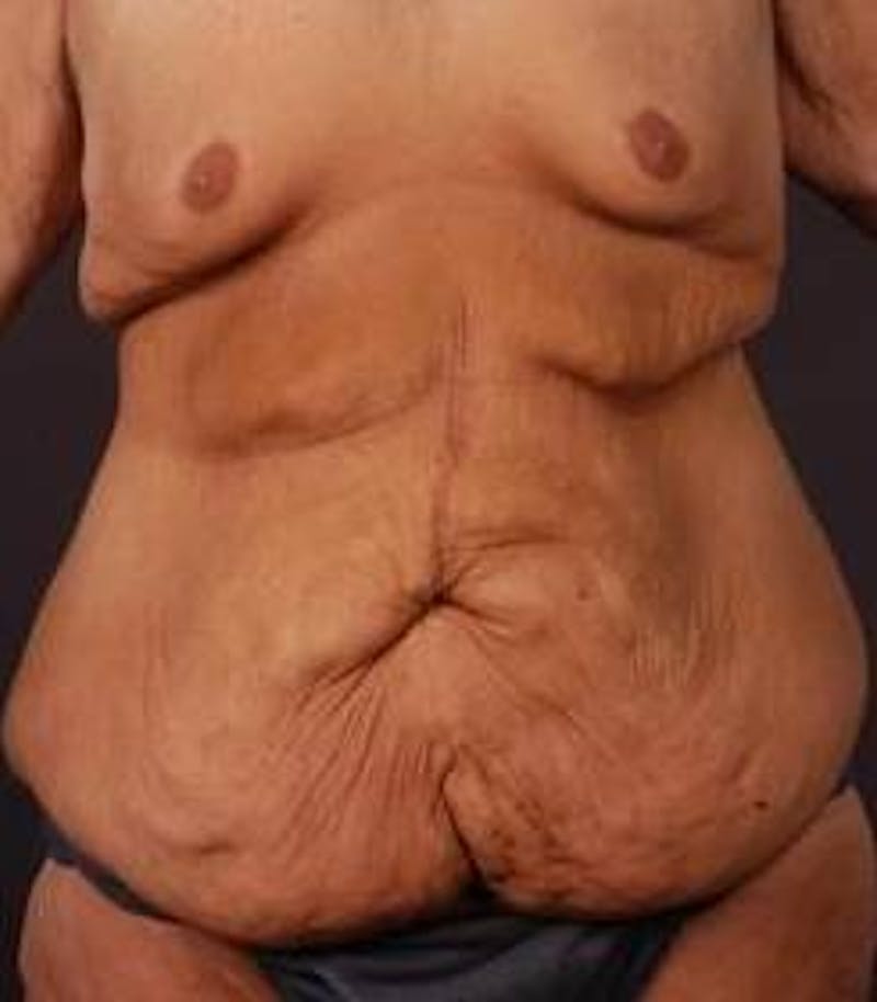 Mastopexy Before & After Gallery - Patient 671175 - Image 1