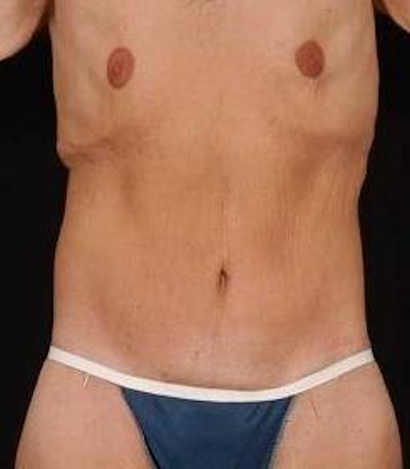 Mastopexy Before & After Gallery - Patient 671175 - Image 2