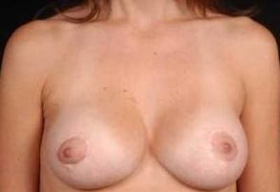 Mastopexy Before & After Gallery - Patient 774283 - Image 2