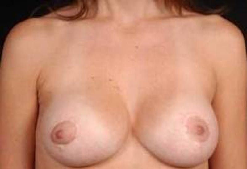 Mastopexy Before & After Gallery - Patient 774283 - Image 2