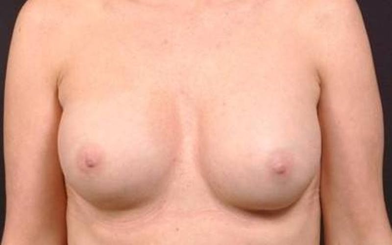 Mastopexy Before & After Gallery - Patient 307349 - Image 1