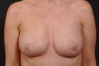 Mastopexy Before & After Gallery - Patient 307349 - Image 2
