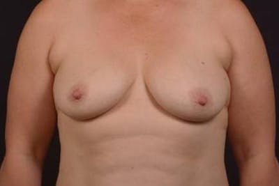 Mastopexy Before & After Gallery - Patient 174097 - Image 1
