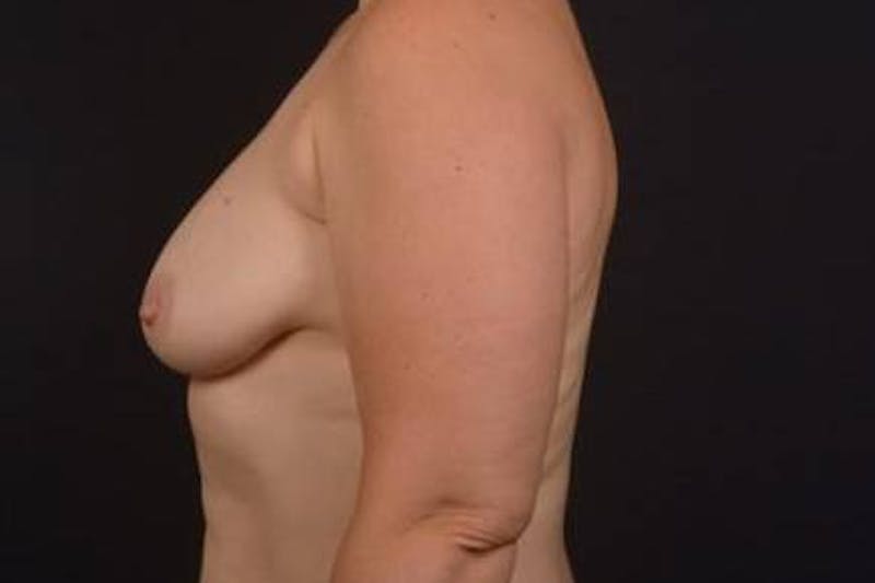Mastopexy Before & After Gallery - Patient 174097 - Image 7