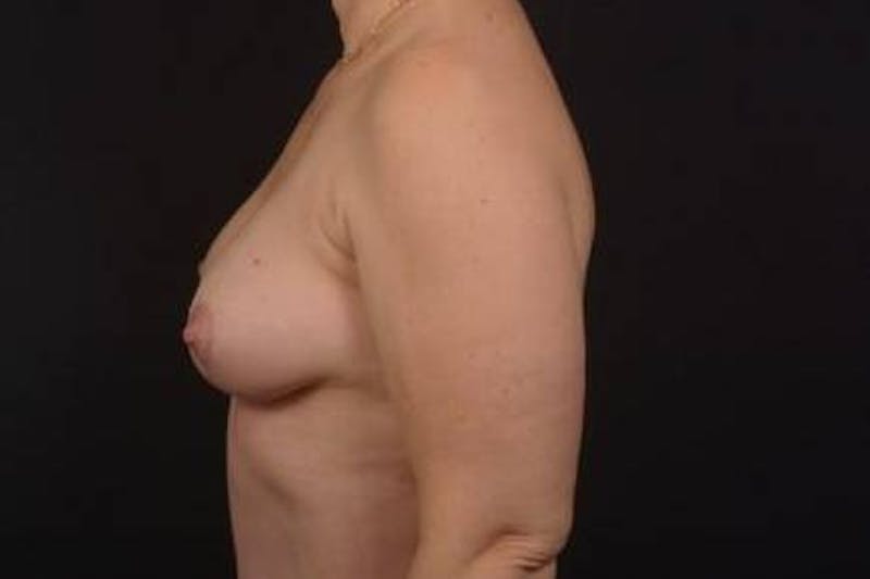 Mastopexy Before & After Gallery - Patient 174097 - Image 8
