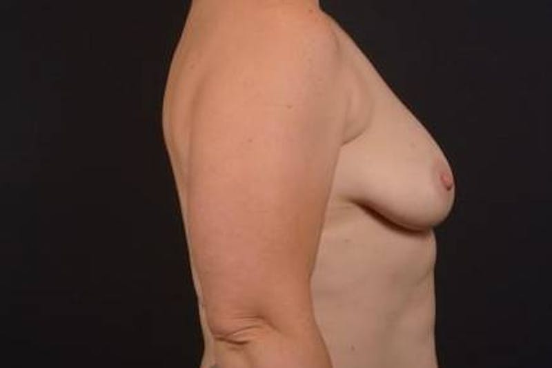 Mastopexy Before & After Gallery - Patient 174097 - Image 9