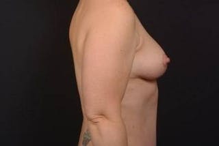 Mastopexy Before & After Gallery - Patient 174097 - Image 10