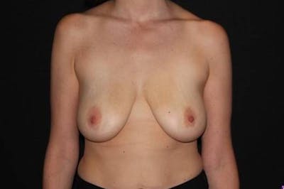 Mastopexy Before & After Gallery - Patient 181437 - Image 1