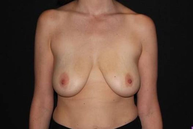 Mastopexy Before & After Gallery - Patient 181437 - Image 1