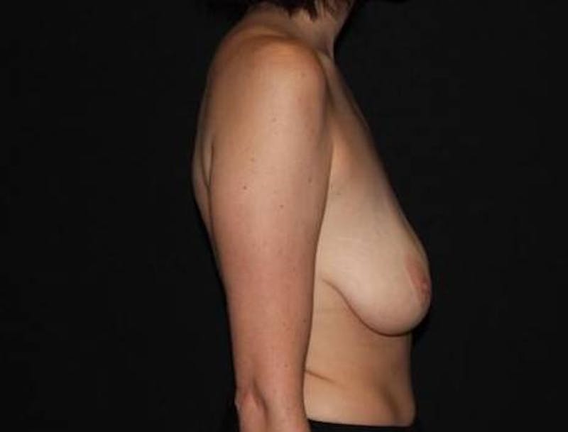 Mastopexy Before & After Gallery - Patient 181437 - Image 9