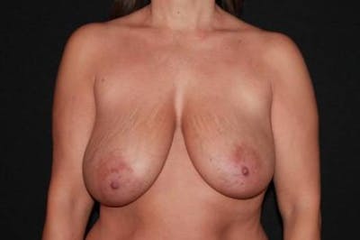 Mastopexy Before & After Gallery - Patient 374951 - Image 1