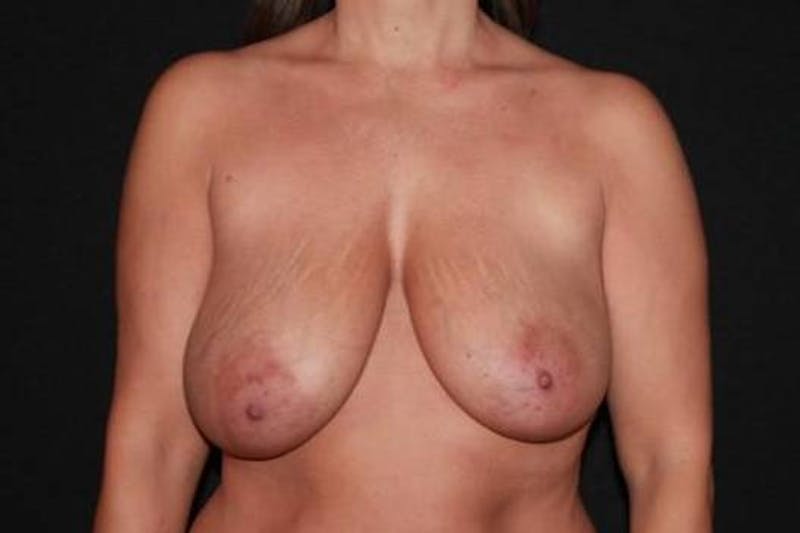 Mastopexy Before & After Gallery - Patient 374951 - Image 1
