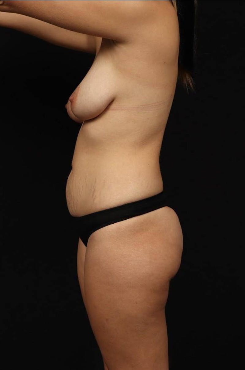 Mastopexy Before & After Gallery - Patient 295726 - Image 5