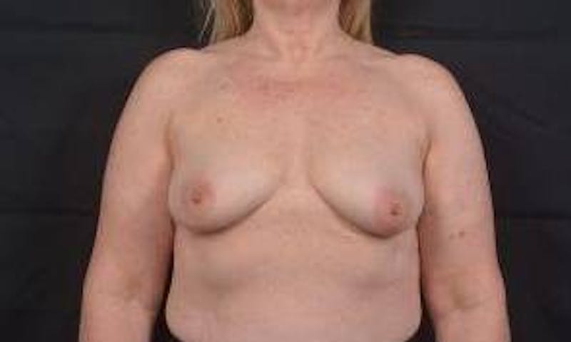 Mastopexy Before & After Gallery - Patient 702514 - Image 1