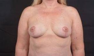 Mastopexy Before & After Gallery - Patient 702514 - Image 2