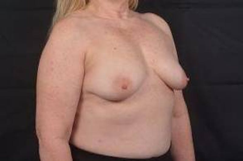 Mastopexy Before & After Gallery - Patient 702514 - Image 9