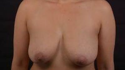 Mastopexy Before & After Gallery - Patient 155574 - Image 1