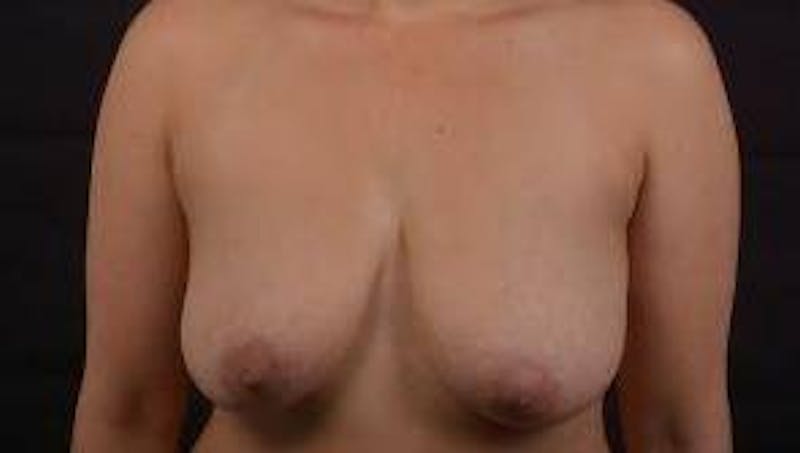 Mastopexy Before & After Gallery - Patient 155574 - Image 1