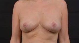 Mastopexy Before & After Gallery - Patient 254841 - Image 2
