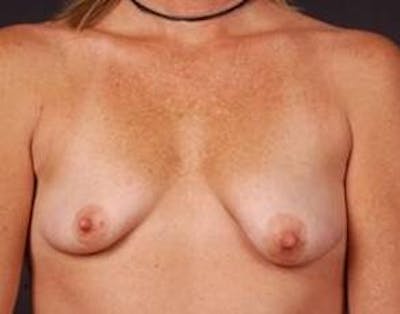 Mastopexy Before & After Gallery - Patient 252324 - Image 1