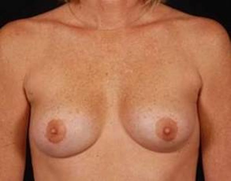 Mastopexy Before & After Gallery - Patient 252324 - Image 2