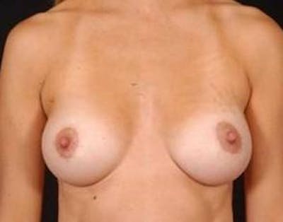 Mastopexy Before & After Gallery - Patient 131728 - Image 2