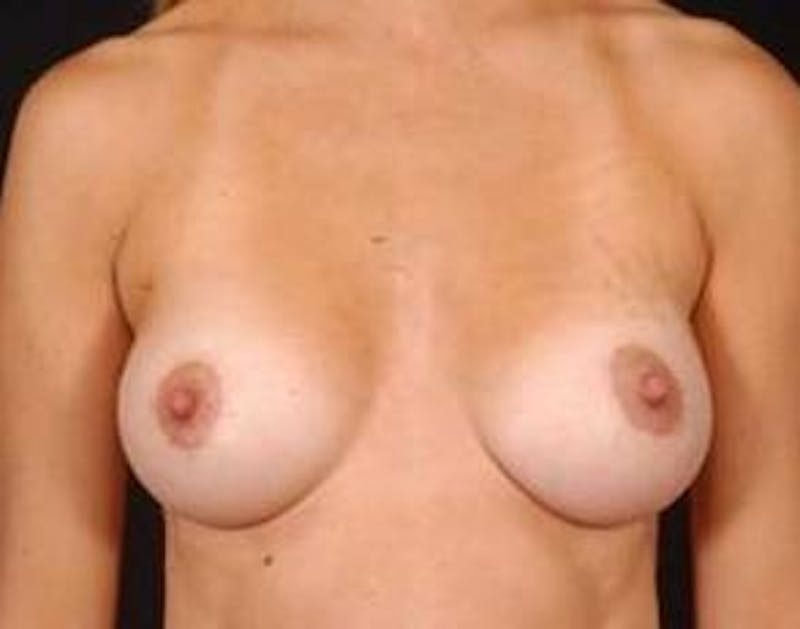 Mastopexy Before & After Gallery - Patient 131728 - Image 2