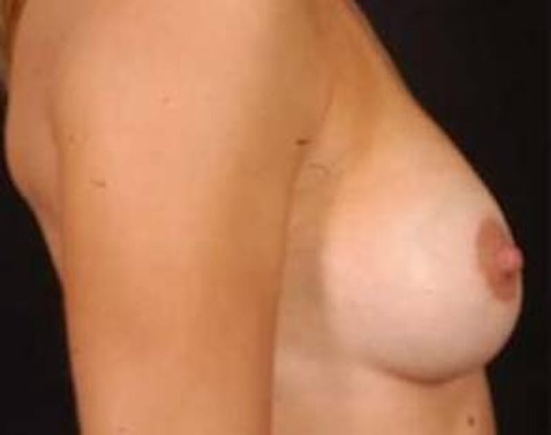 Mastopexy Before & After Gallery - Patient 131728 - Image 6