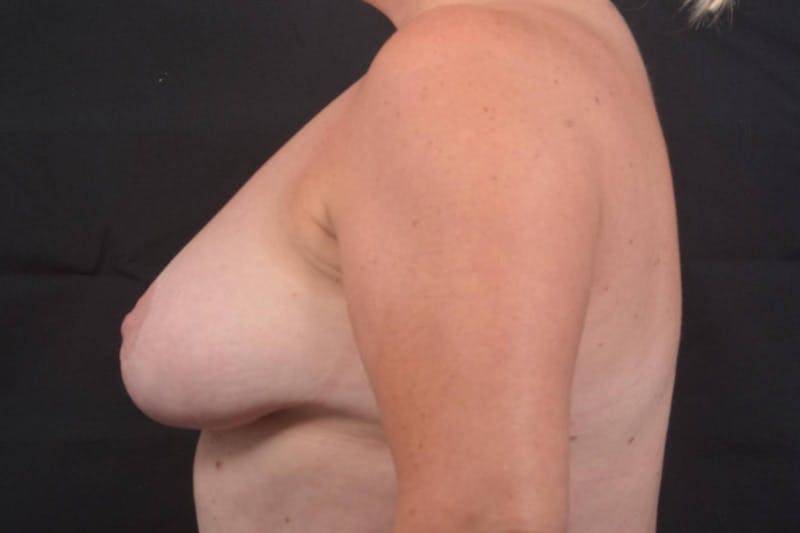 Mastopexy Before & After Gallery - Patient 383629 - Image 3