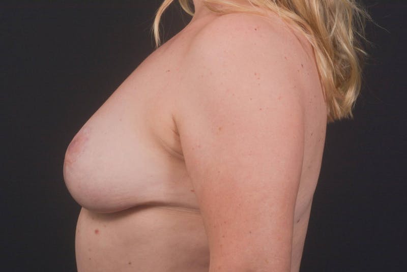 Mastopexy Before & After Gallery - Patient 383629 - Image 4
