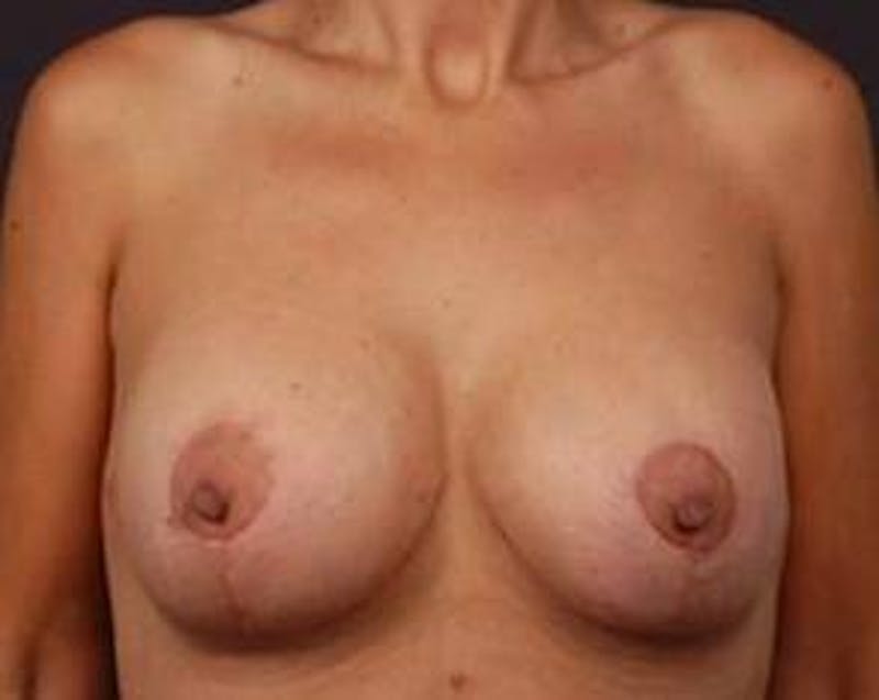 Mastopexy Before & After Gallery - Patient 372118 - Image 2